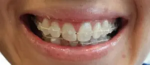 Face Braces | True Dental West Kelowna