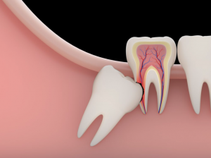 west-kelowna-dentist-teeth-cleaning-wisdom