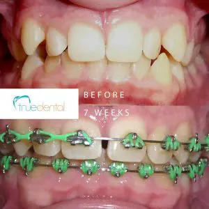 kelowna-perfect-smile-before-and-during-straight-teeth-in-less-than-120-days-front-image-progress