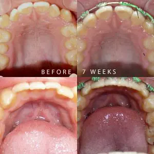 kelowna-perfect-smile-before-and-during-straight-teeth-in-less-than-120-days-inside-progress