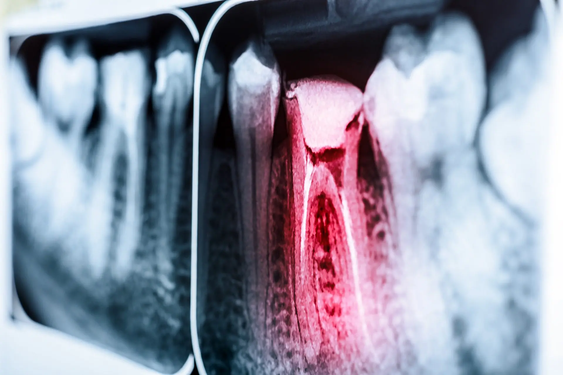 infected-tooth-XRay-root-canal-procedure