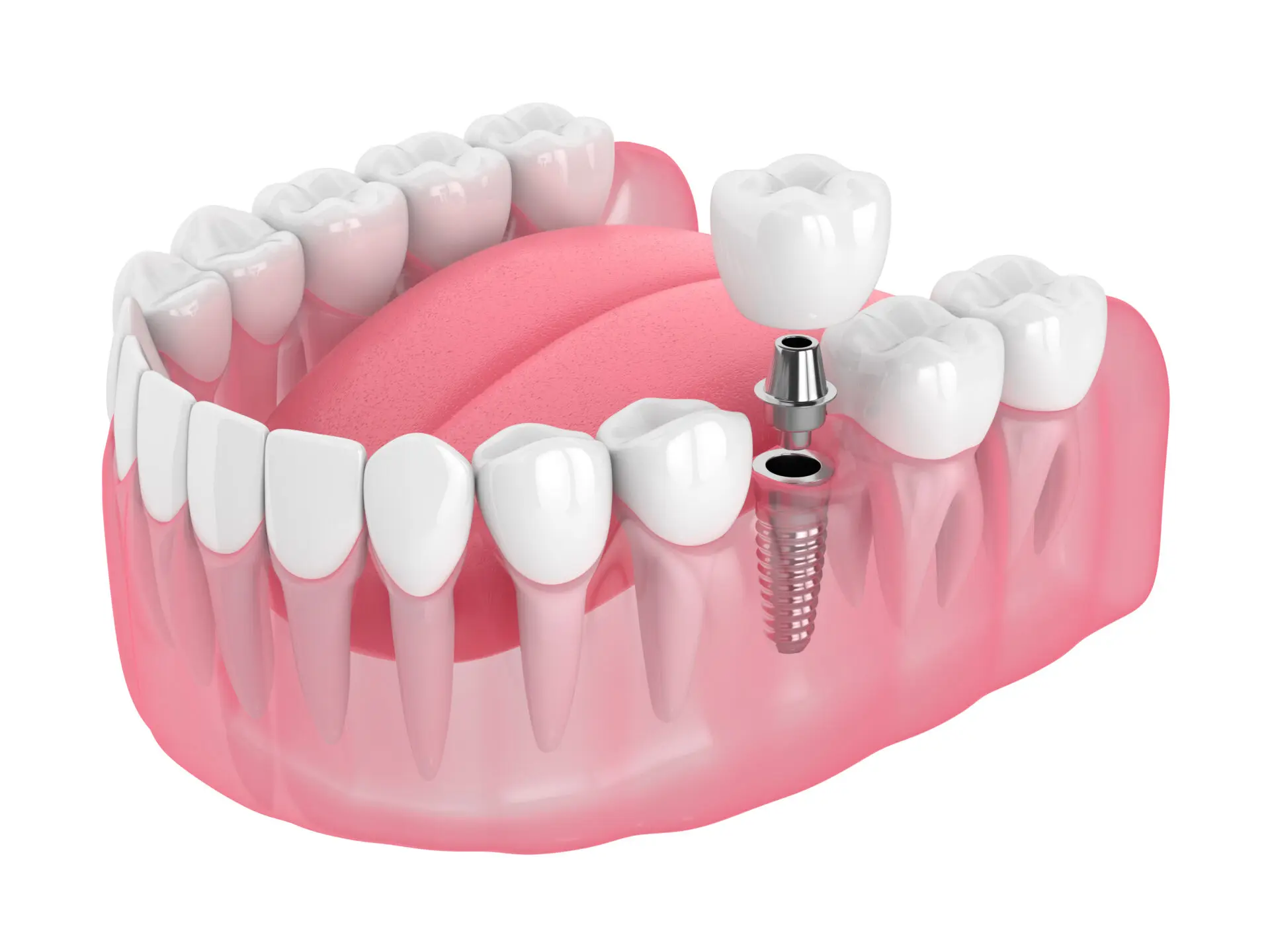 Dental implants near me