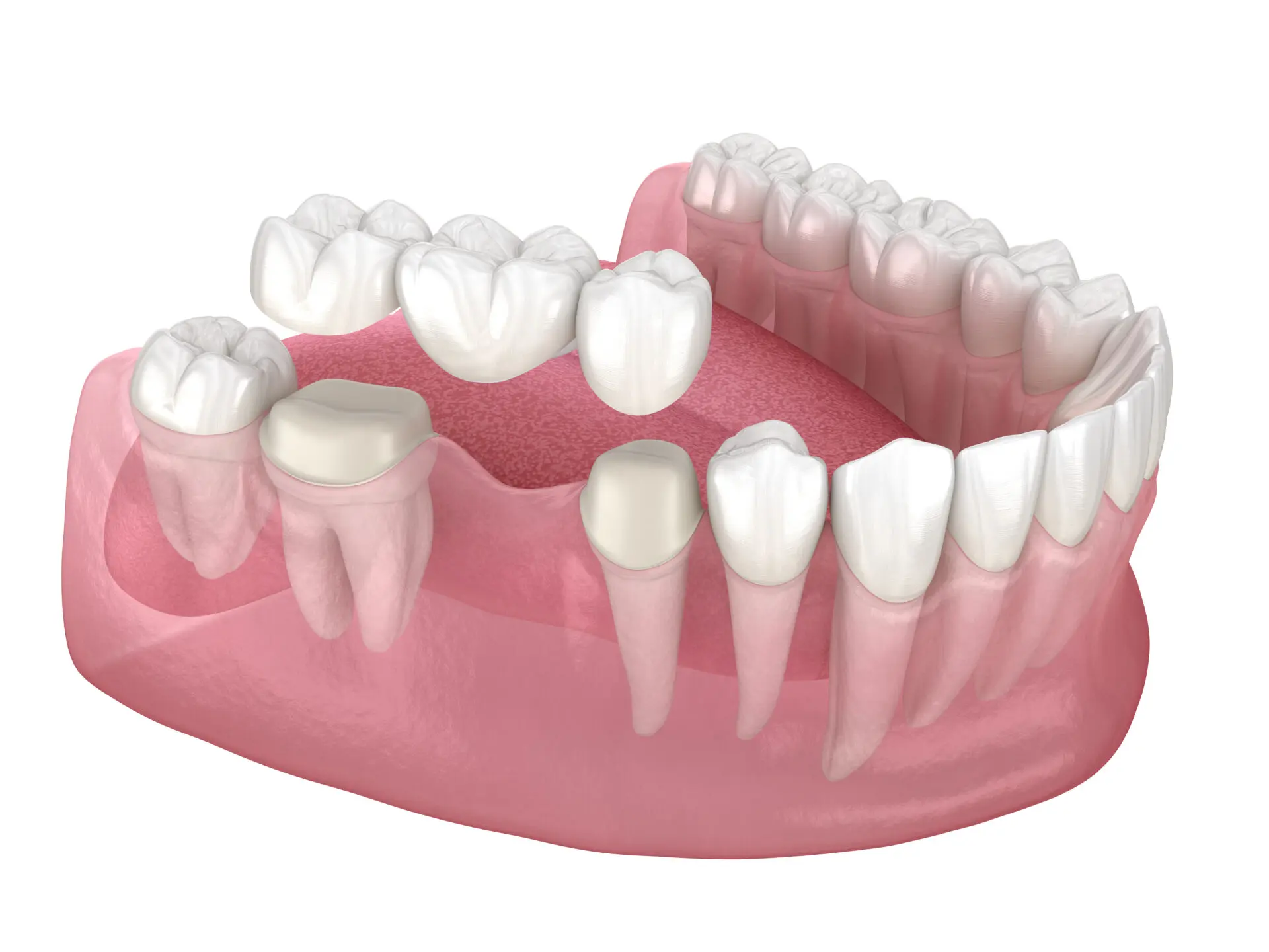 tooth bridge cost