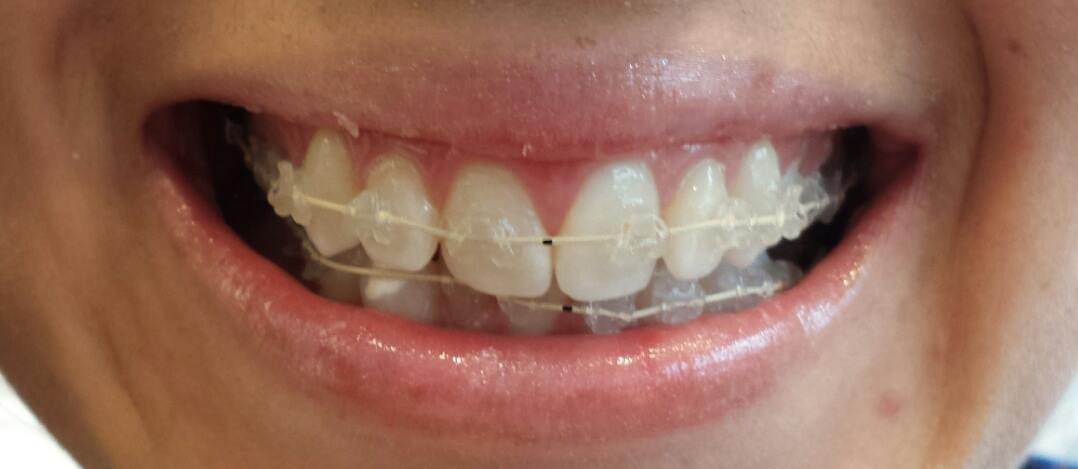 fastbraces clear dental braces kelowna fast true brackets dr teeth macrae don