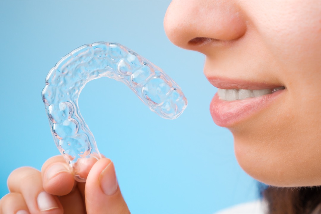 Clear aligners for adult braces