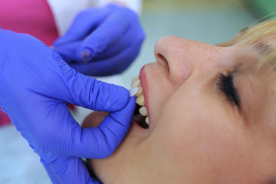 Women getting dental veneers placed on teeth