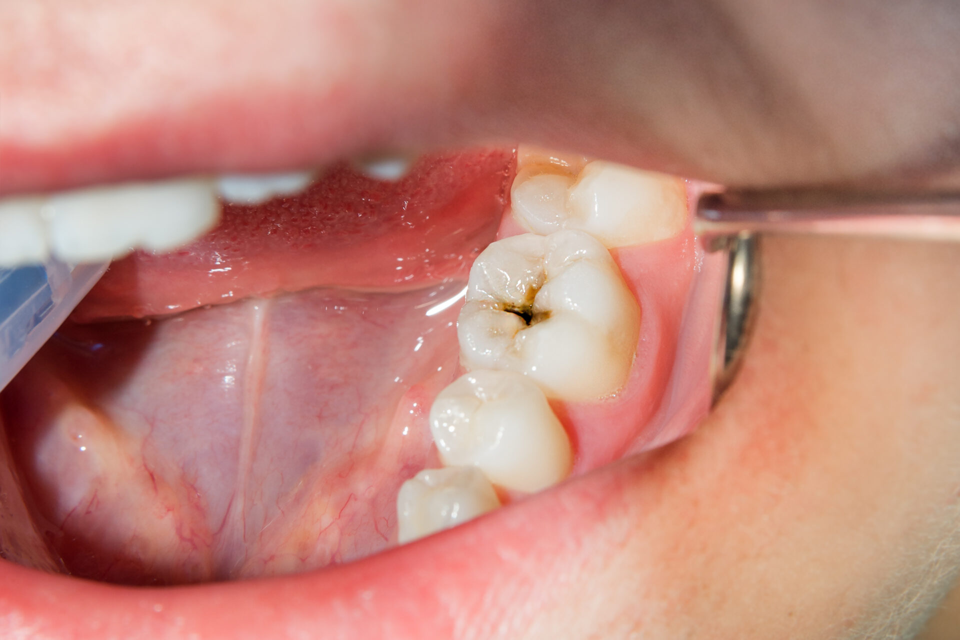 How Long Can a Cavity Go Untreated? | True Dental