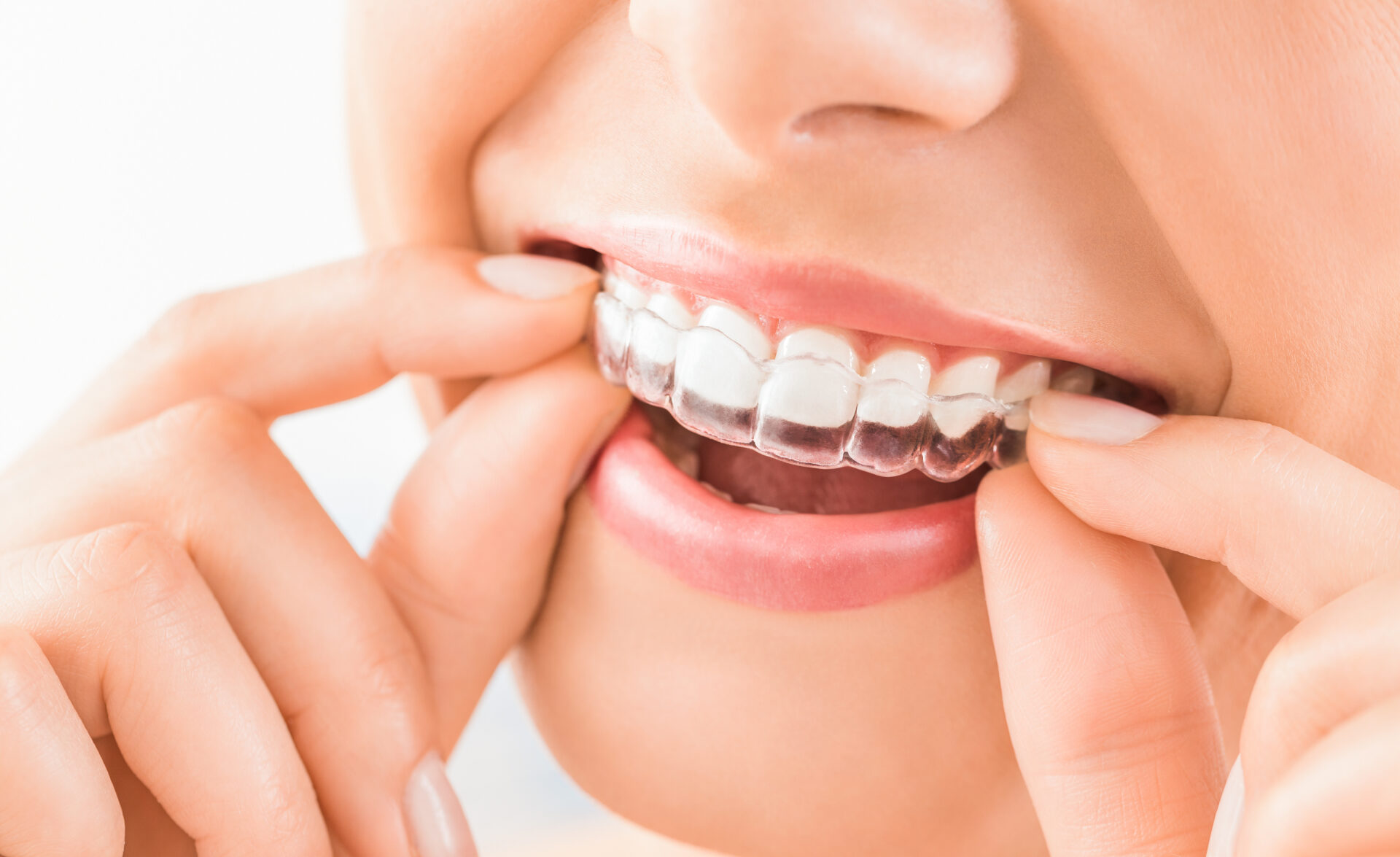 Orthodontics using Invisalign kelowna