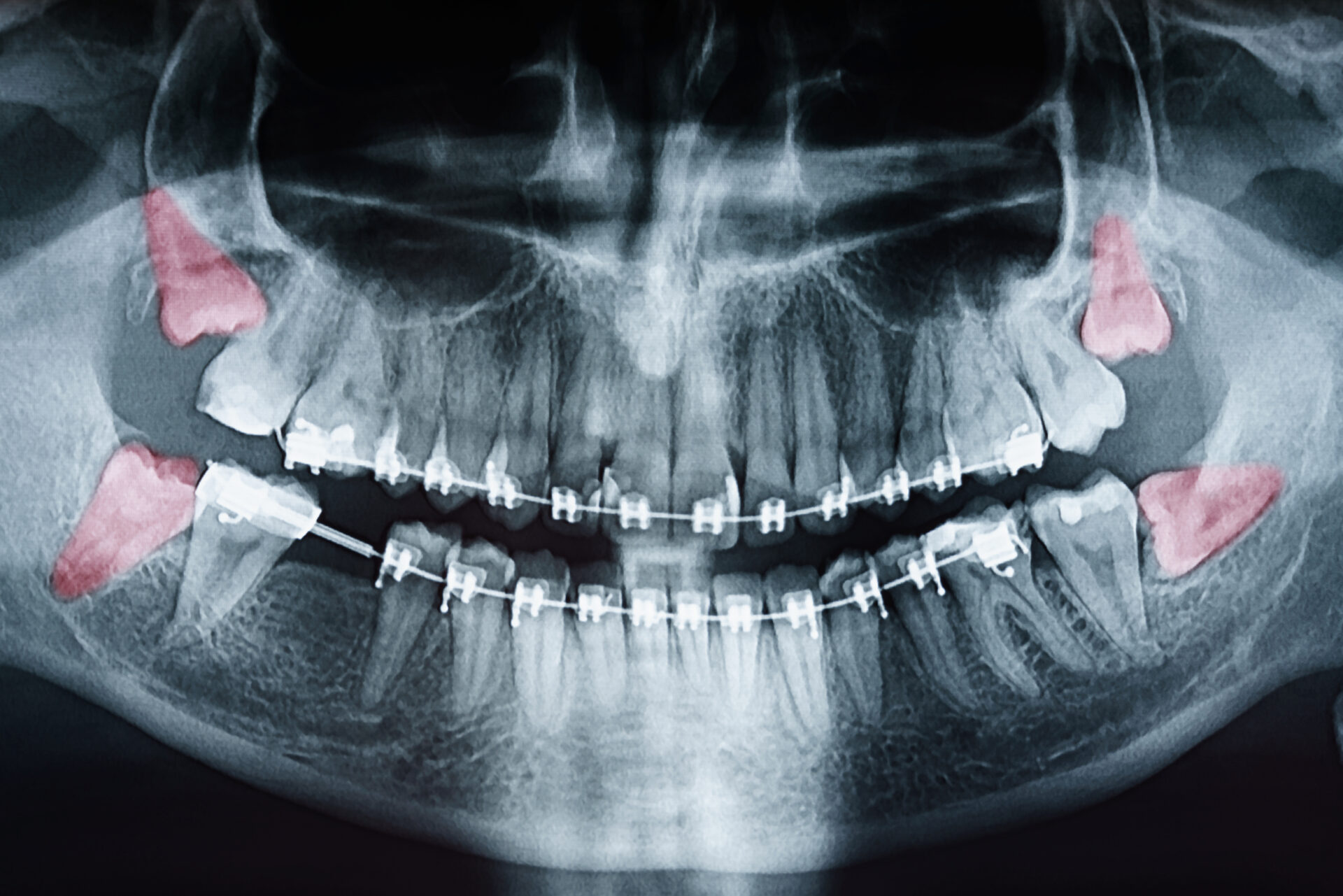 wisdom tooth pain kelowna