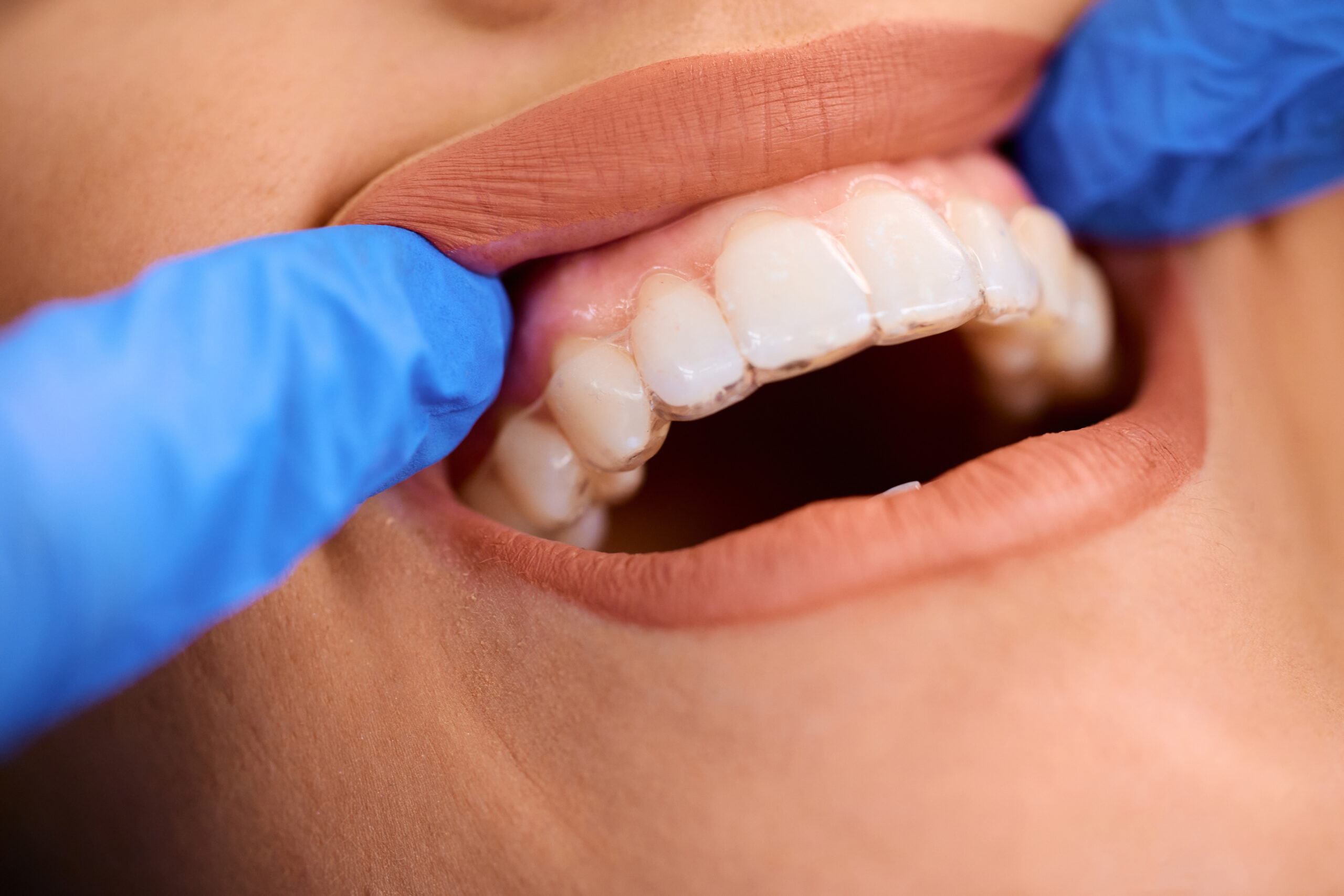 Fastbraces vs Invisalign