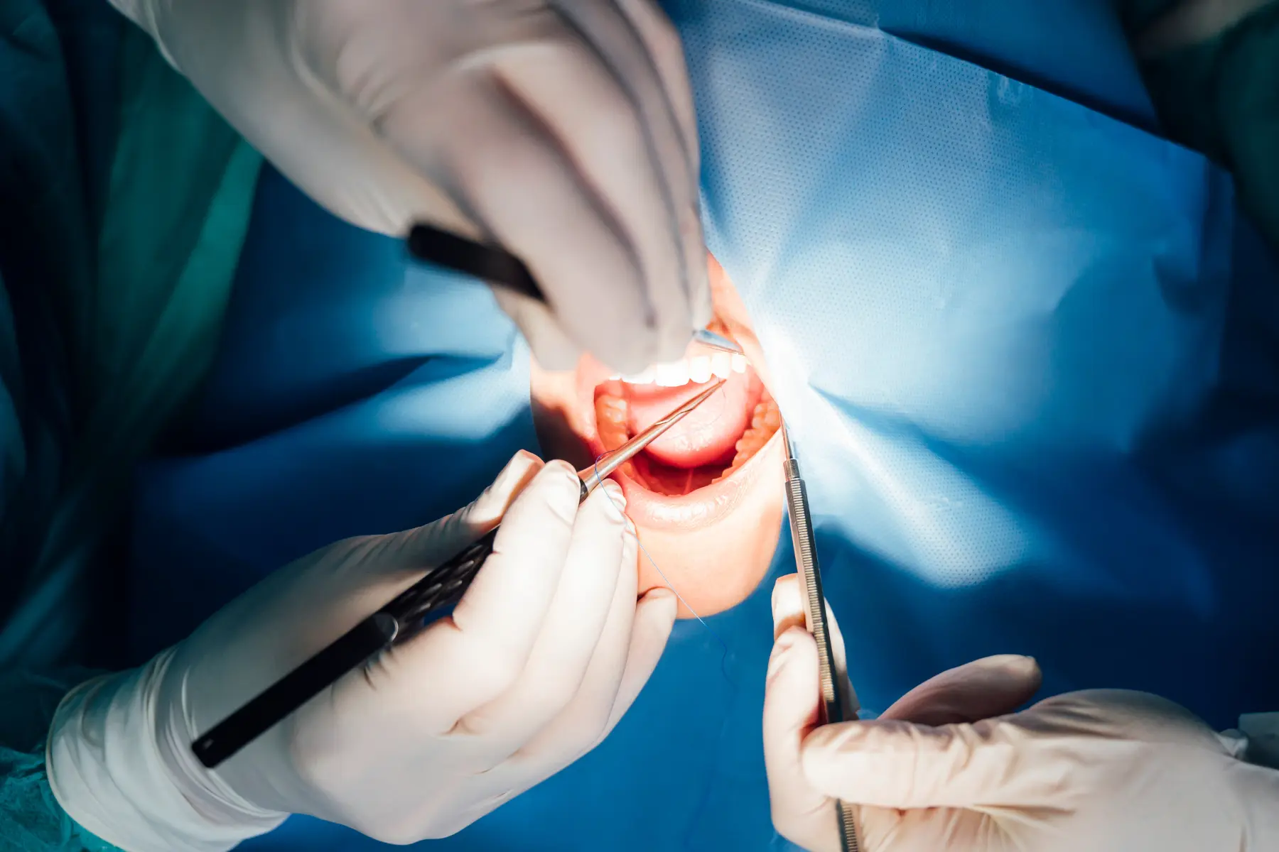 Wisdom tooth removal West Kelowna Dental